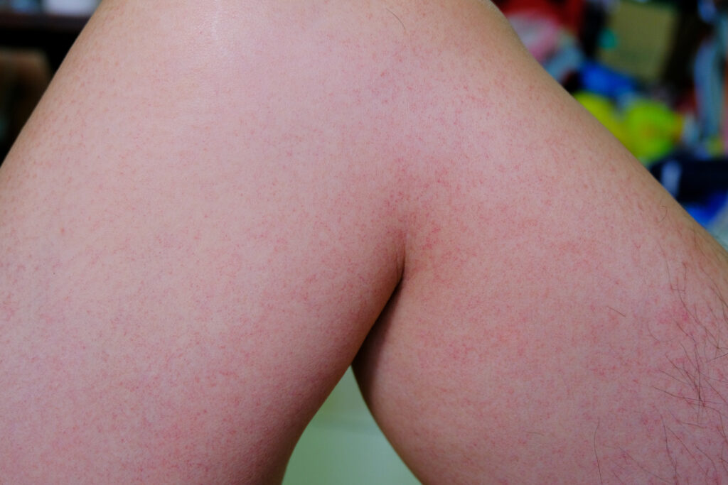 As manchas vermelhas e erupções cutâneas são sintomas típicos da doença causada pelo aedes aegypti, que surgem após o período de incubação.